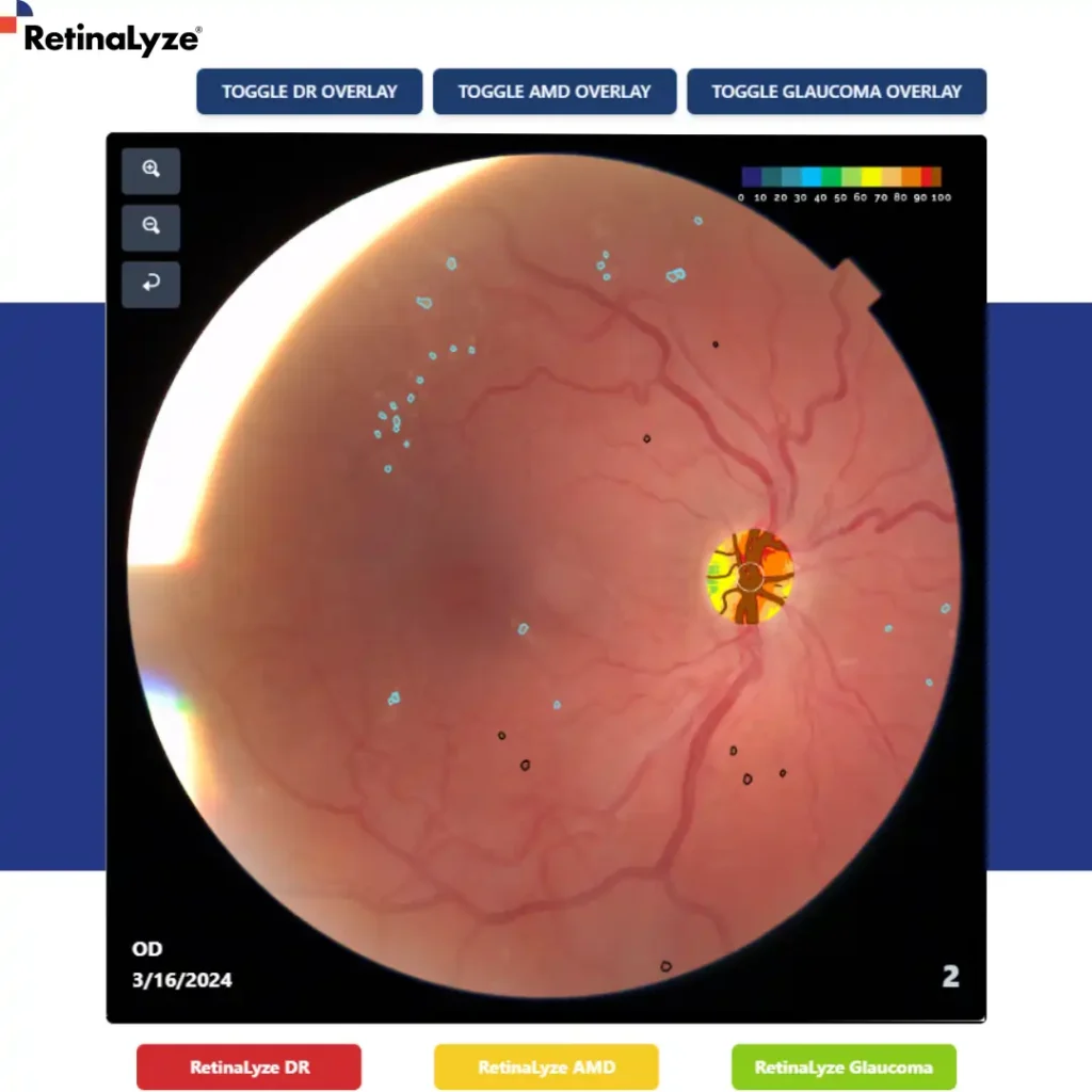 retinopatia-diabetica-glaucoma-dmri