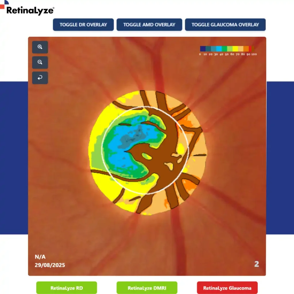 retinopatia-diabetica-glaucoma-dmri