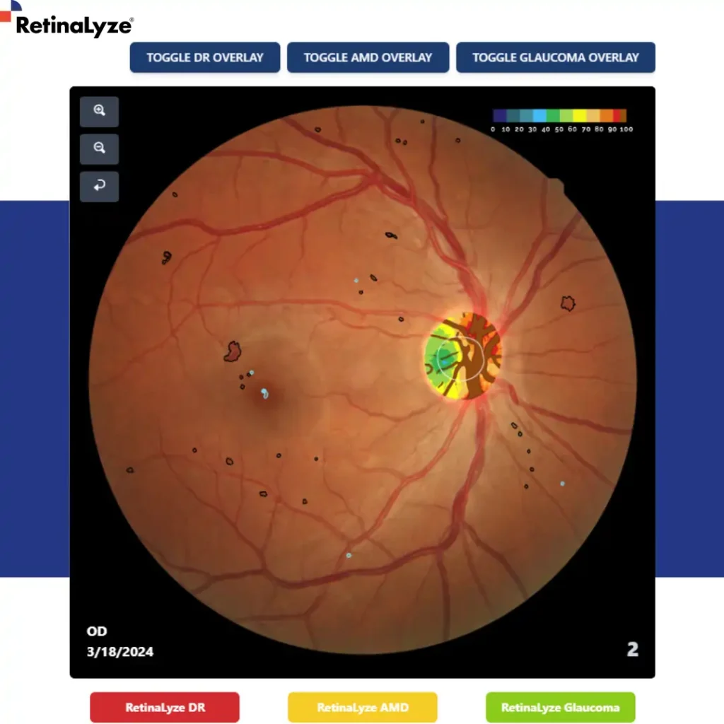 retinopatia-diabetica-glaucoma-dmri