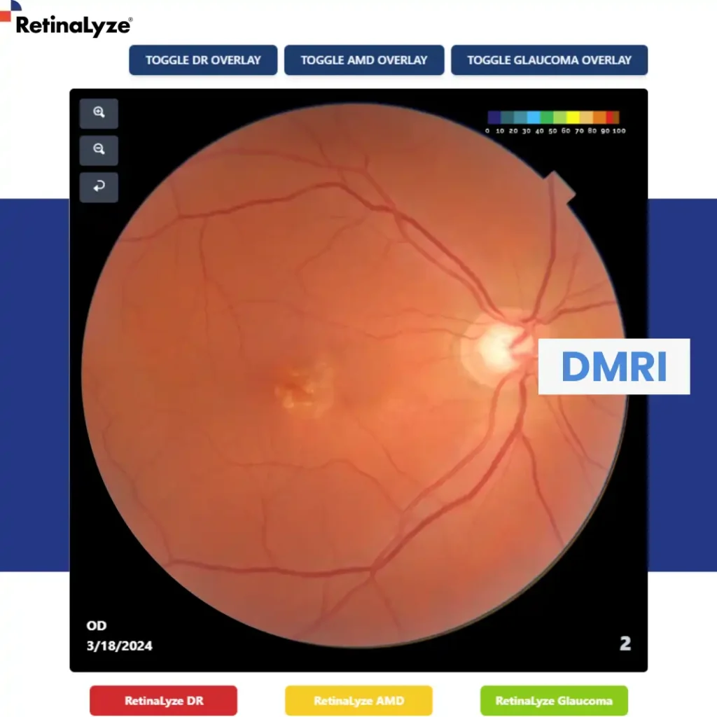 retinmopatia-diabetica retinalyze glaucoma - diabetes visao ocular