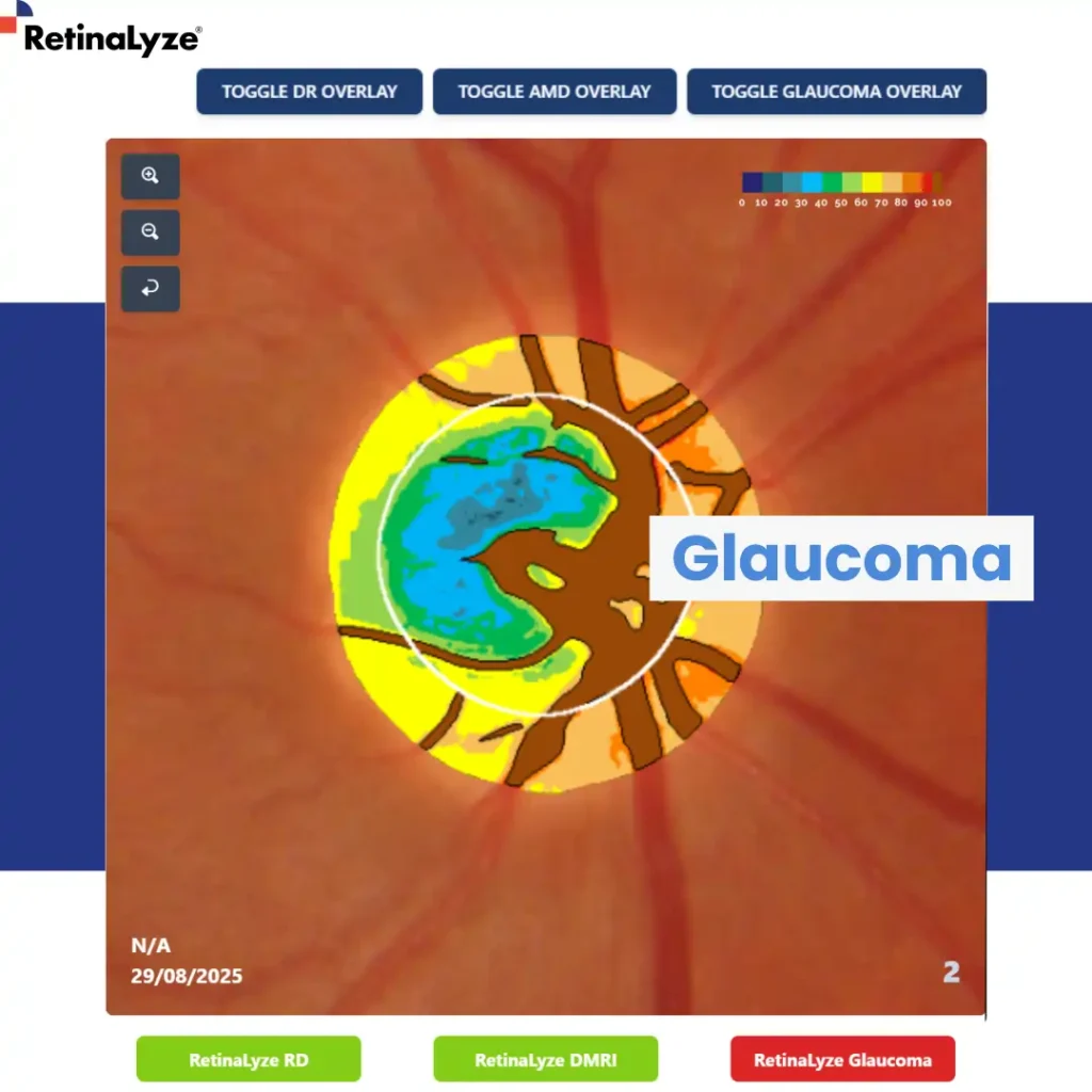 retinmopatia-diabetica retinalyze glaucoma - diabetes visao ocular