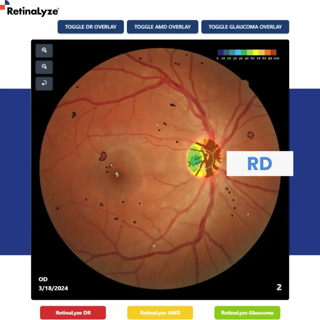 retinmopatia-diabetica